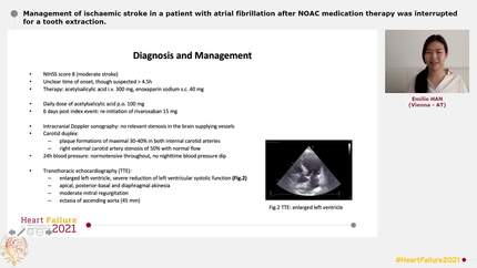 Management of ischaemic stroke in a patient with atrial fibrillation after NOAC medication therapy was interrupted for a tooth extraction.