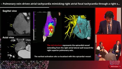 Pulmonary vein–driven atrial tachycardia mimicking right atrial focal tachycardia through a right superior pulmonary vein–right atrial connection