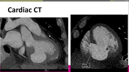 A rare complication of myocardial infarction: pseudoaneurysm leading to ischaemic VSD
