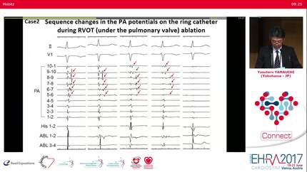 Ablation at uncommon sites.