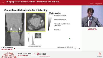 Imaging assessment of leaflet thrombosis and pannus.