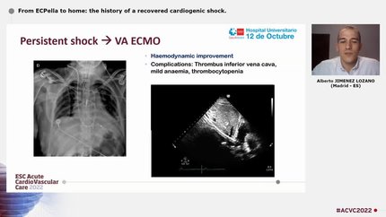 From ECPella to home: the history of a recovered cardiogenic shock.