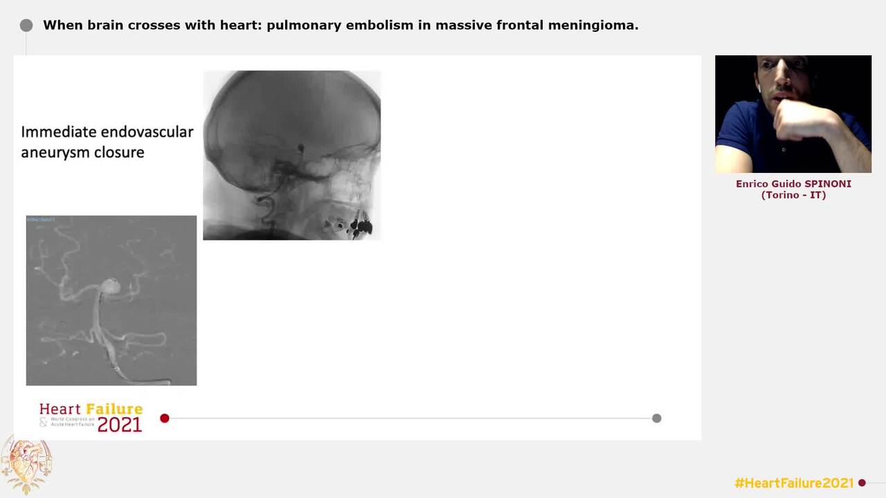 When brain crosses with heart: pulmonary embolism in massive frontal meningioma.