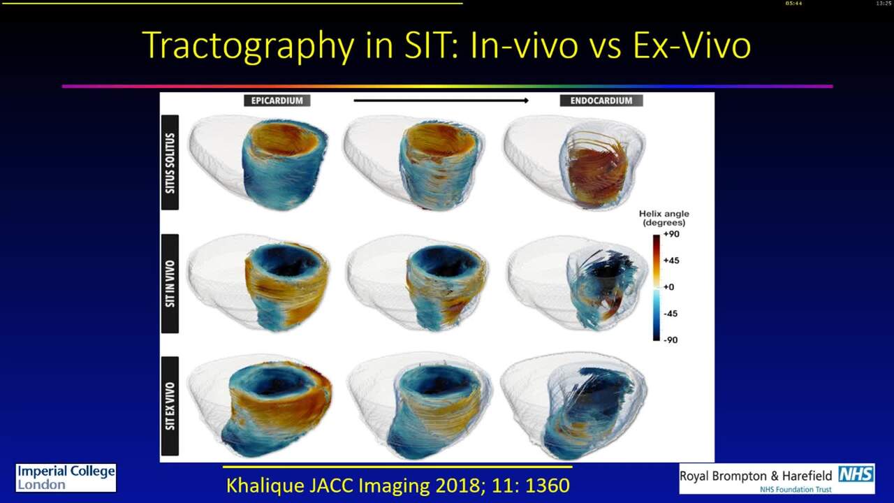 CMR imaging of myocardial fibers: do we need it?