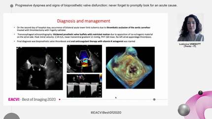 Progressive dyspnea and signs of bioprosthetic valve disfunction: never forget to promptly look for an acute cause.