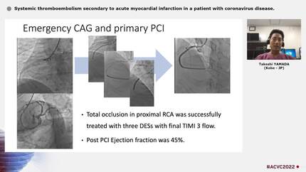 Systemic thromboembolism secondary to acute myocardial infarction in a patient with coronavirus disease.