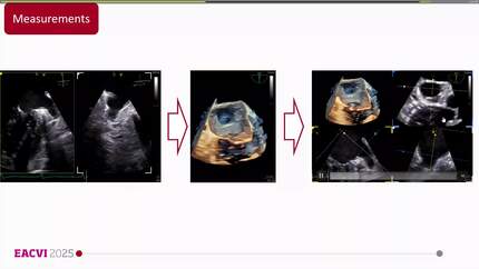 Echocardiography vs. computed tomography coronary angiography (CTCA) for assessment of the left atrial appendage