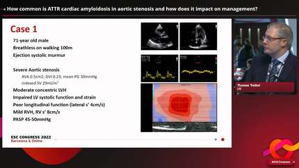 Management of cardiac transthyretin amyloidosis with or without aortic stenosis