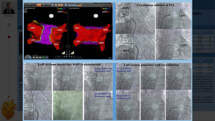 Atrial fibrillation cryoablation in heart failure patients with systolic dysfunction: long-term period outcomes