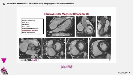 Subaortic restenosis: multimodality imaging makes the difference.
