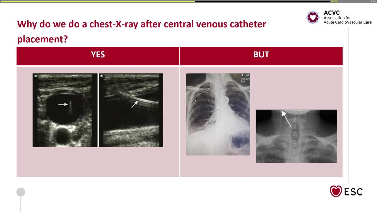 Why do we do a chest -X-ray after central venous catheter placement?