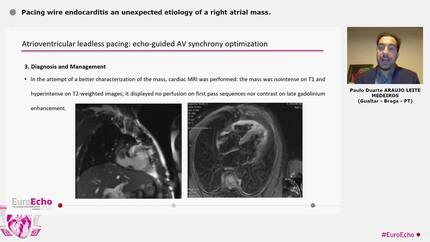 Pacing wire endocarditis  an unexpected etiology of a right atrial mass.