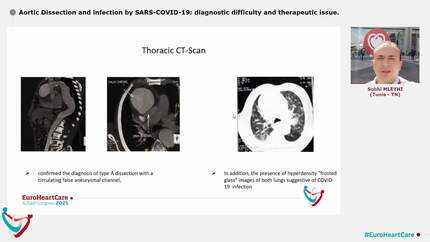Aortic Dissection and infection by SARS-COVID-19: diagnostic difficulty and therapeutic issue.