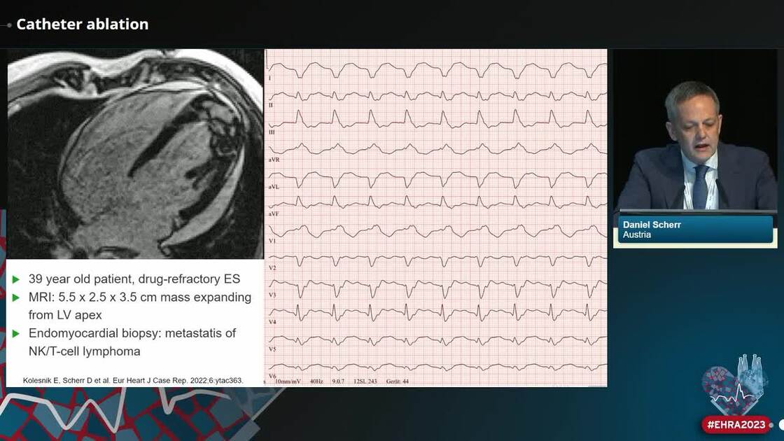 ESC 365 Catheter ablation