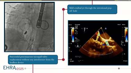 An alternative approach: leadless device implantation via the internal jugular vein to minimize interference with a new percutaneous tricuspid valve replacement procedure.