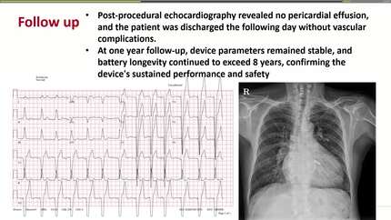 Technical challenges and solutions for extracting leadless pacemakers in the patient with post-VSD patch closure