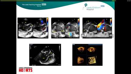 Atrial conundrum in a rare case of dextrocardia, common atrium and totally anomalous pulmonary venous drainage