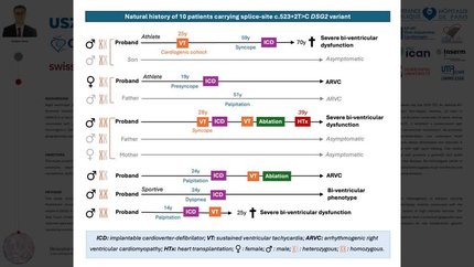 Desmoglein-2 splice-site variant associated with arrhythmogenic right ventricular cardiomyopathy: description of ten patients and hypothesis of a founder effect