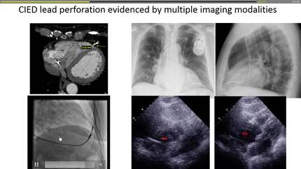 The management of cardiac implantable electronic device (CIED) lead perforation: A multicenter study