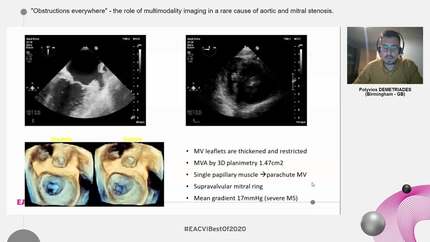 "Obstructions everywhere" - the role of multimodality imaging in a rare cause of aortic and mitral stenosis.