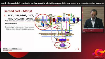 Arrhythmogenic left ventricular cardiomyopathy mimicking myocarditis recurrences in a young Caucasian woman: a case report of a novel DSP mutation.