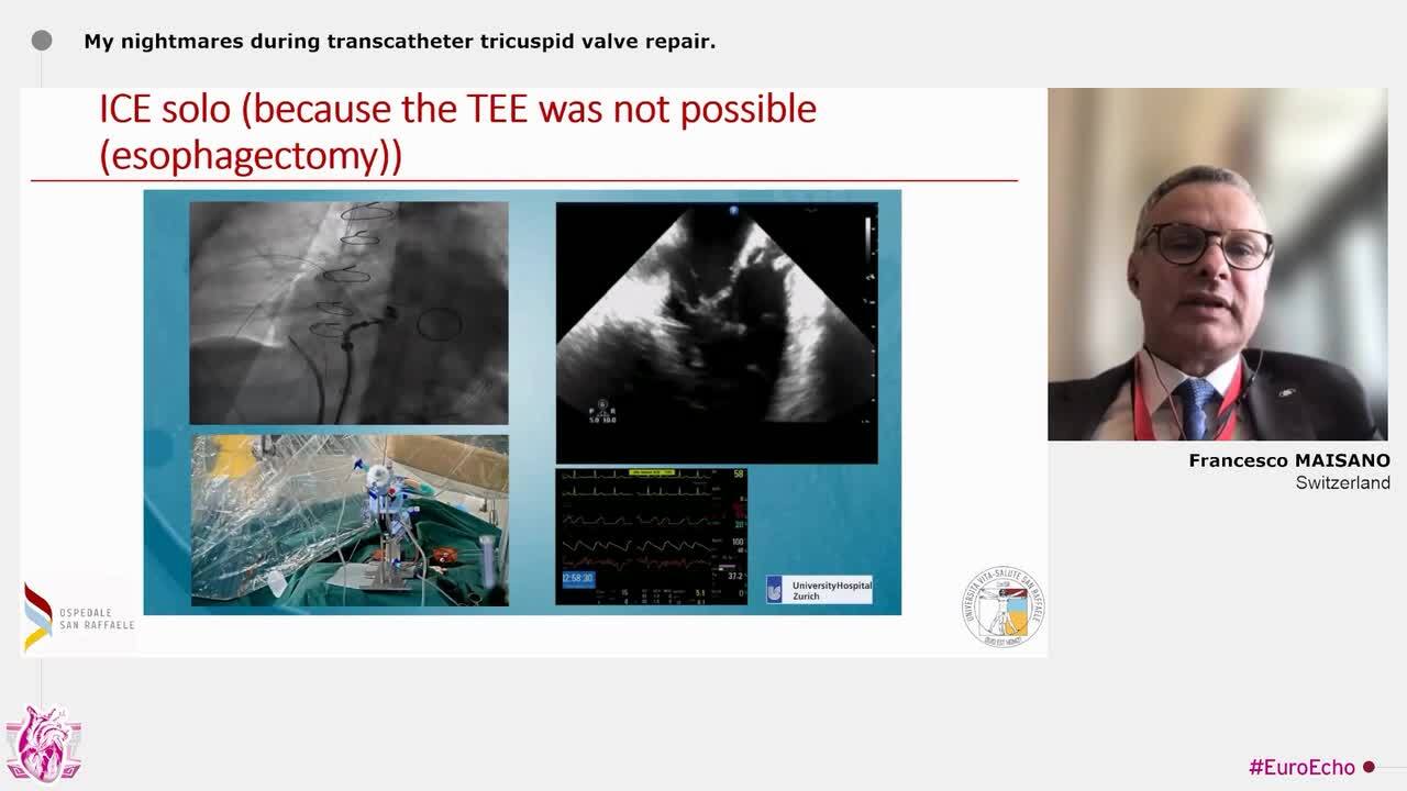 ‘The winter is coming…’: the most challenging complications in interventional echocardiography