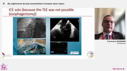 ‘The winter is coming…’: the most challenging complications in interventional echocardiography