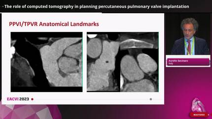 The role of computed tomography in planning percutaneous pulmonary valve implantation