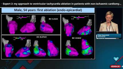 My approach to ventricular tachycardia ablation in patients with non-ischaemic cardiomyopathy