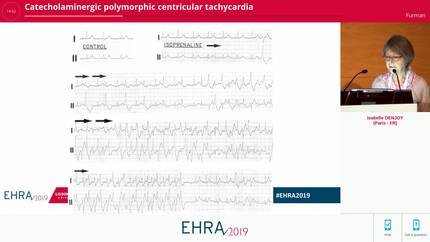 Catecholaminergic polymorphic centricular tachycardia