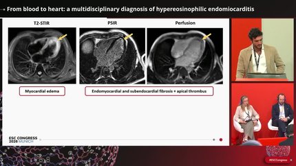 From blood to heart: a multidisciplinary diagnosis of hypereosinophilic endomiocarditis