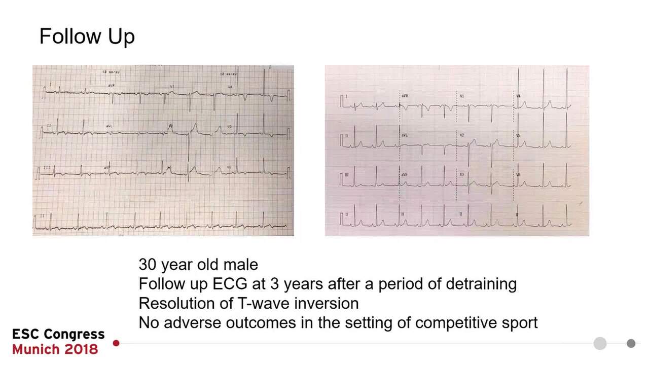Inferolateral T-wave inversion in athletes: phenotype-genotype correlation