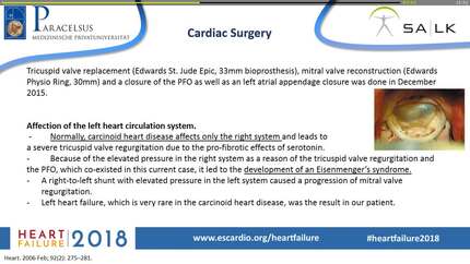 Right and left heart failure due to carcinoid heart disease complicated by a PFO with right-to-left shunt: a case report 