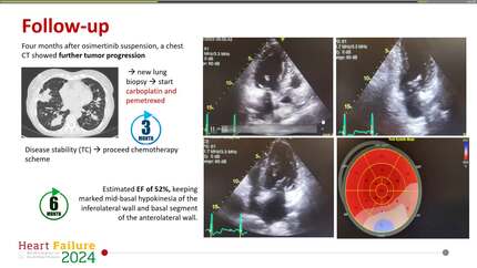 Osimertinib-induced heart failure.