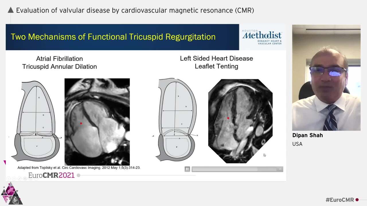 Evaluation of valvular disease by cardiovascular magnetic resonance (CMR)