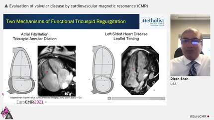Evaluation of valvular disease by cardiovascular magnetic resonance (CMR)