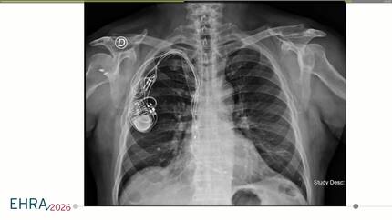 Hybrid management of intermittent pacing system dysfunction in a pacemaker dependent patient with prior endocarditis and bilateral subclavian vein obstruction