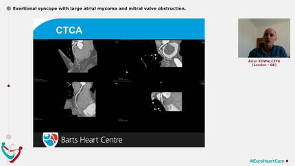 Exertional syncope with large atrial myxoma and mitral valve obstruction.