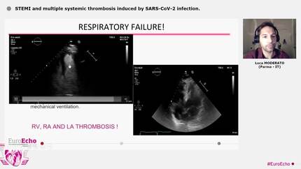 STEMI and multiple systemic thrombosis induced by SARS-CoV-2 infection.