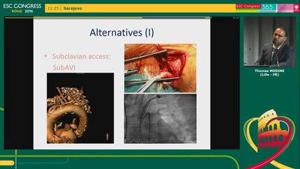 TAVI: finding the right access