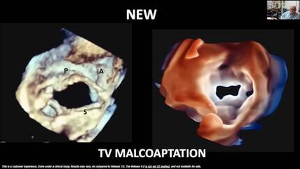 Transthoracic echo like you've never seen before. 