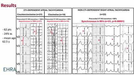 The timing of the P-wave in V1-V6 precordial transition allows to identify the mechanism of right atrial tachycardia
