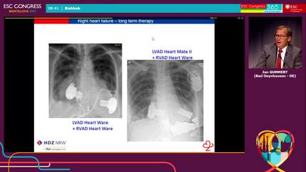 State of the Art: ventricular assist devices - Most recent developments 
