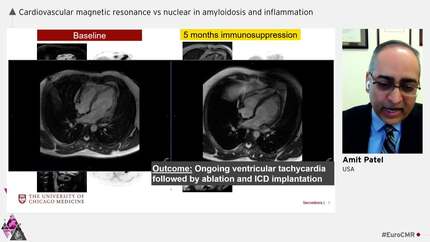 Sarcoidosis: CMR is king.