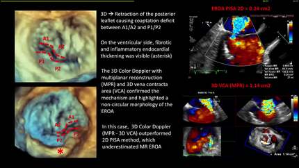 An unusual case of mitral regurgitation in the hematology ward: the role of multimodality imaging