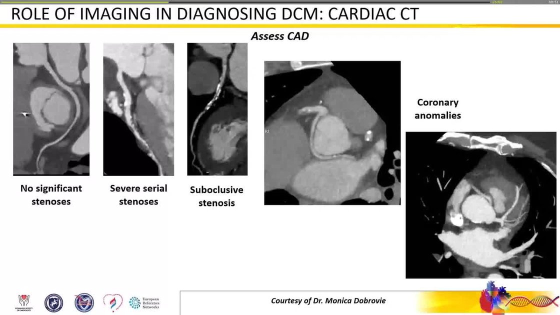 ESC 365 - Dilated cardiomyopathy