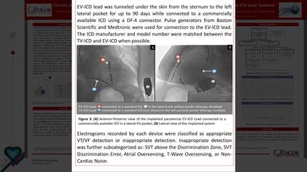 Chronic ambulatory sensing comparison between intercostal extravascular versus transvenous ICD lead systems