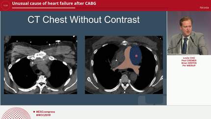 Unusual cause of heart failure after CABG
