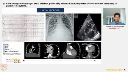 Cardiomyopathy with right atrial thrombi, pulmonary embolism and peripheral artery embolism secondary to pheochromocytoma.