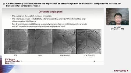 An unexpectedly unstable patient the importance of early recognition of mechanical complications in acute ST-Elevation Myocardial Infarctions.